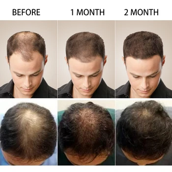Prirodna эссенция rast kose za žene, muškarce protiv gubitka kose Tretman za sprječavanje gubitka kose Glatke zadebljanje za njegu kose eterično ulje