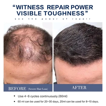2 komada rast kose Ulje эссенция zgušnjavanja agent za rast kose serum gubitak kose proizvod je prirodni ekstrakt ulje tekuće brzi rast kose